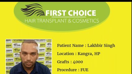Lakhbir's Hair Transplant Procedure @FCHTC Clinic Ludhiana - 4000 hair grafts