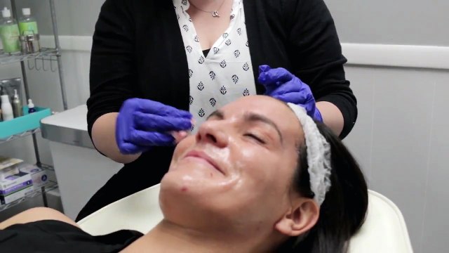 Microneedling Skin Rejuvenation - Is It Really Helpful?
