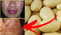 COMO CLAREAR MANCHAS ESCURAS DA PELE RECEITA CASEIRA COM BATATA