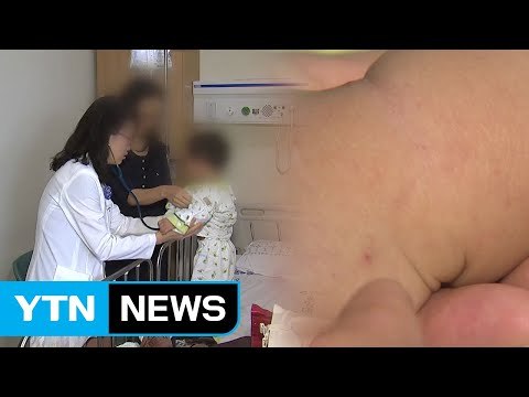 수두 환자 증가... 제때 예방접종 하세요 / YTN