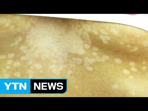 폭염 속 땀 범벅...내 피부 노리는 '어루러기' 조심 / YTN (Yes! Top News)