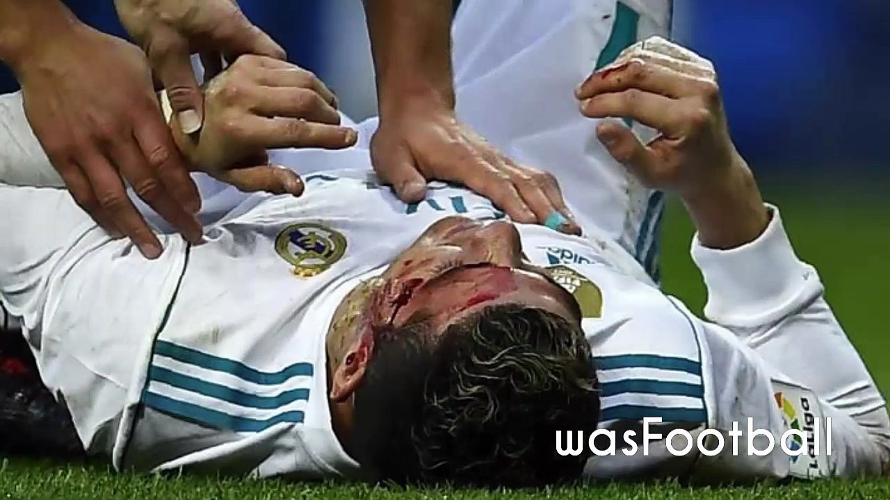 2 Dias depois Olho de CR7 continua roxo e inchado após choque