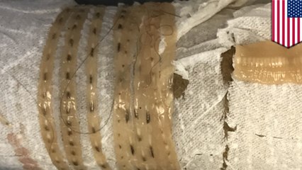 閲覧注意！体内から長さ1.6メートルの寄生虫　刺身が原因か　米 - トモニュース