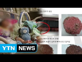 "덜 익은 패티로 '햄버거병' 걸렸다" 맥도날드 피소 / YTN