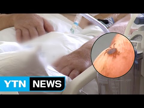 강원도에서 60대 여성 야생 진드기에 물려 숨져 / YTN