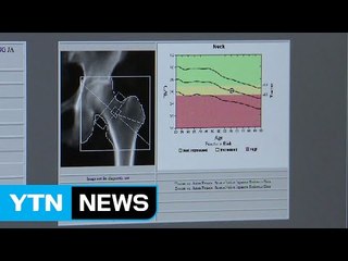 뚜렷한 증상없는 골다공증, 조기 진단해야 / YTN (Yes! Top News)
