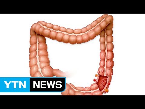 맹장 쓸모있다...제거한 사람 질병 회복속도 늦어 / YTN (Yes! Top News)