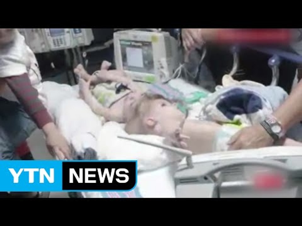 머리 붙은 쌍둥이, 16시간 수술 끝에 분리 성공 / YTN (Yes! Top News)