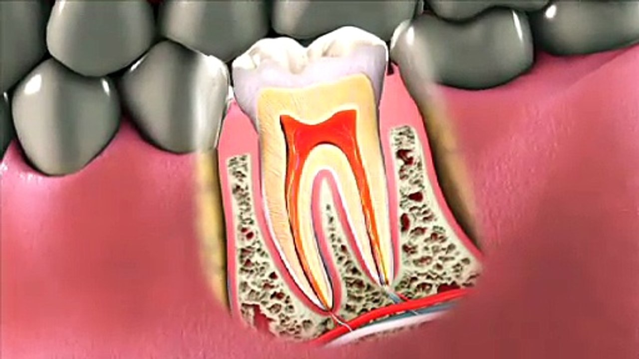 Root Canal Therapy