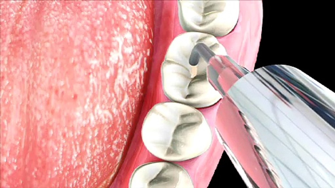 Sealants & Mouth Guards