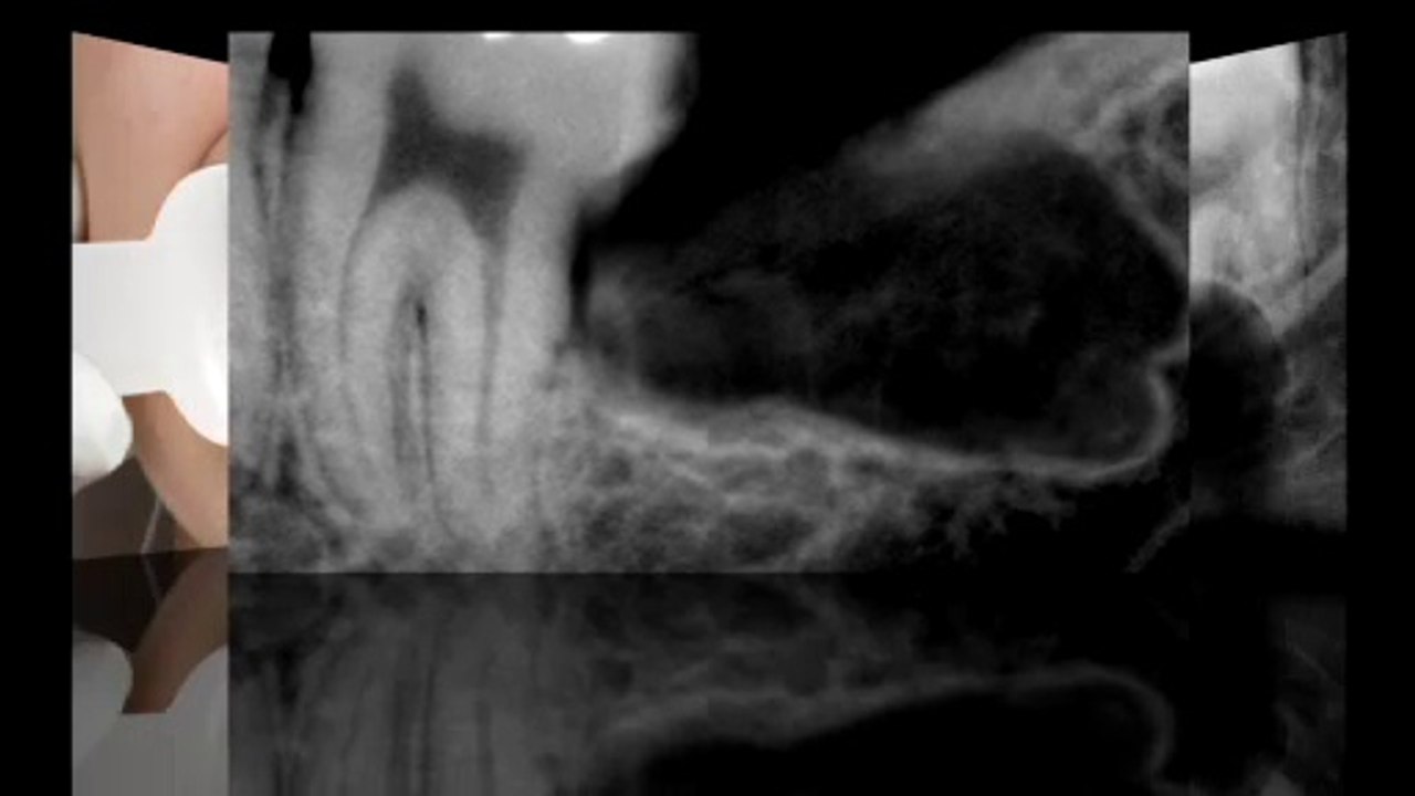 Wisdom Teeth