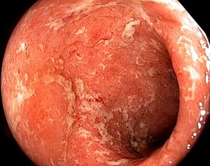 Ulcerative Colitis