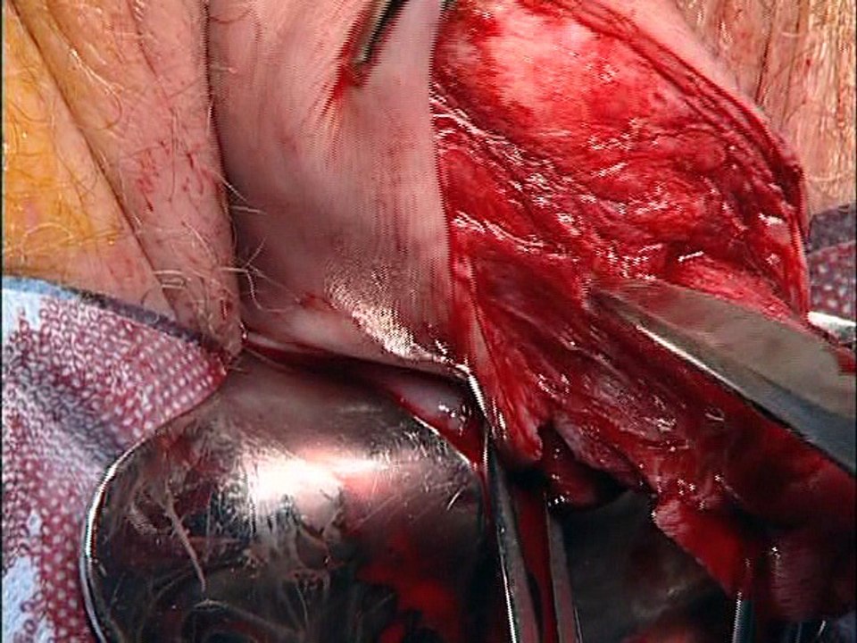 Difficult anterior entry