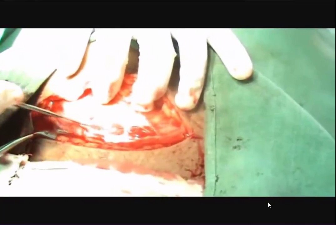 Joel Cohen's Incision The Blunt Opening