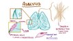 Mesothelioma - causes, symptoms, diagnosis, treatment, pathology - YouTube