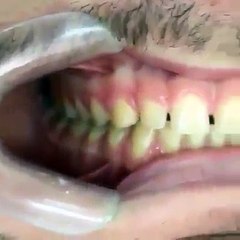 How to Close Gaps Between Teeth