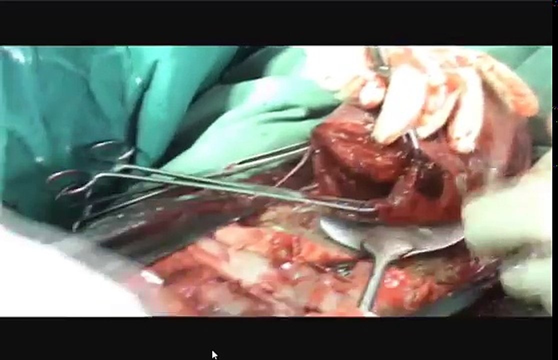 LSCS with Joel Cohen's Incision with Breech Delivery