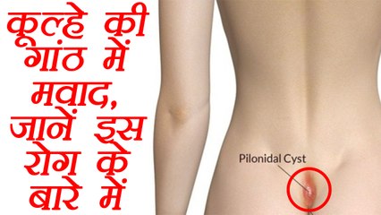 Pilonidal Cyst: कूल्हे की गांठ में मवाद, जानें इस बीमारी के बारे में | Lump in hip joint | Boldsky