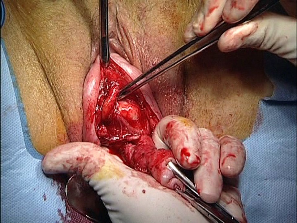 Anatomy of organ prolapse