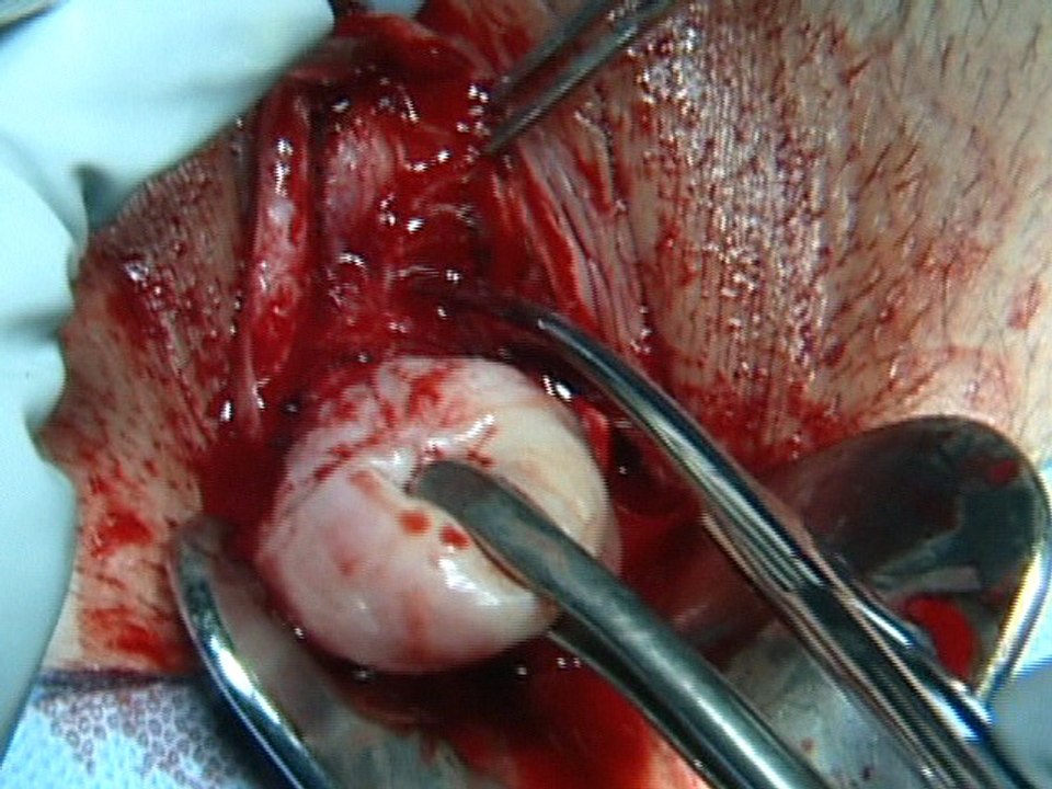 Anterior cul du sac entry