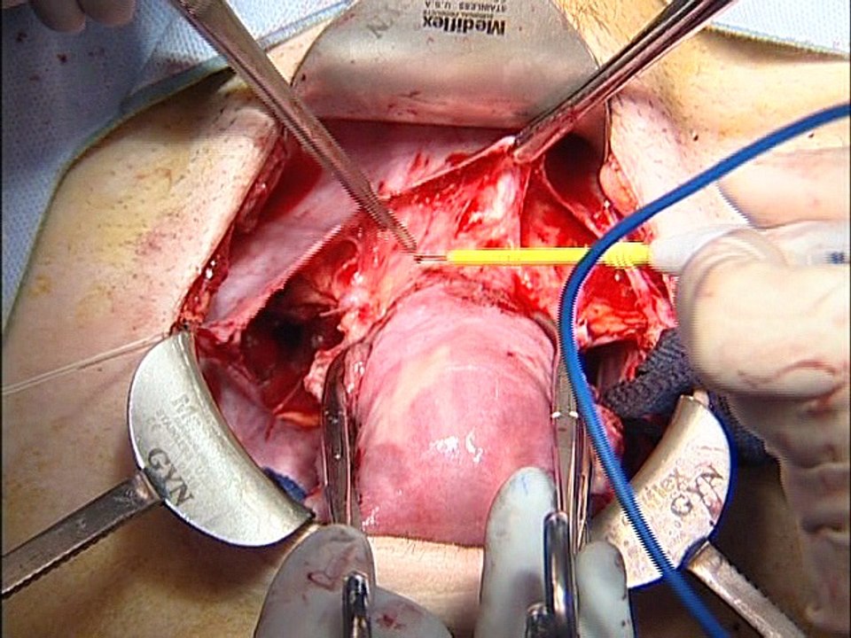 Avascular Spaces in the pelvis