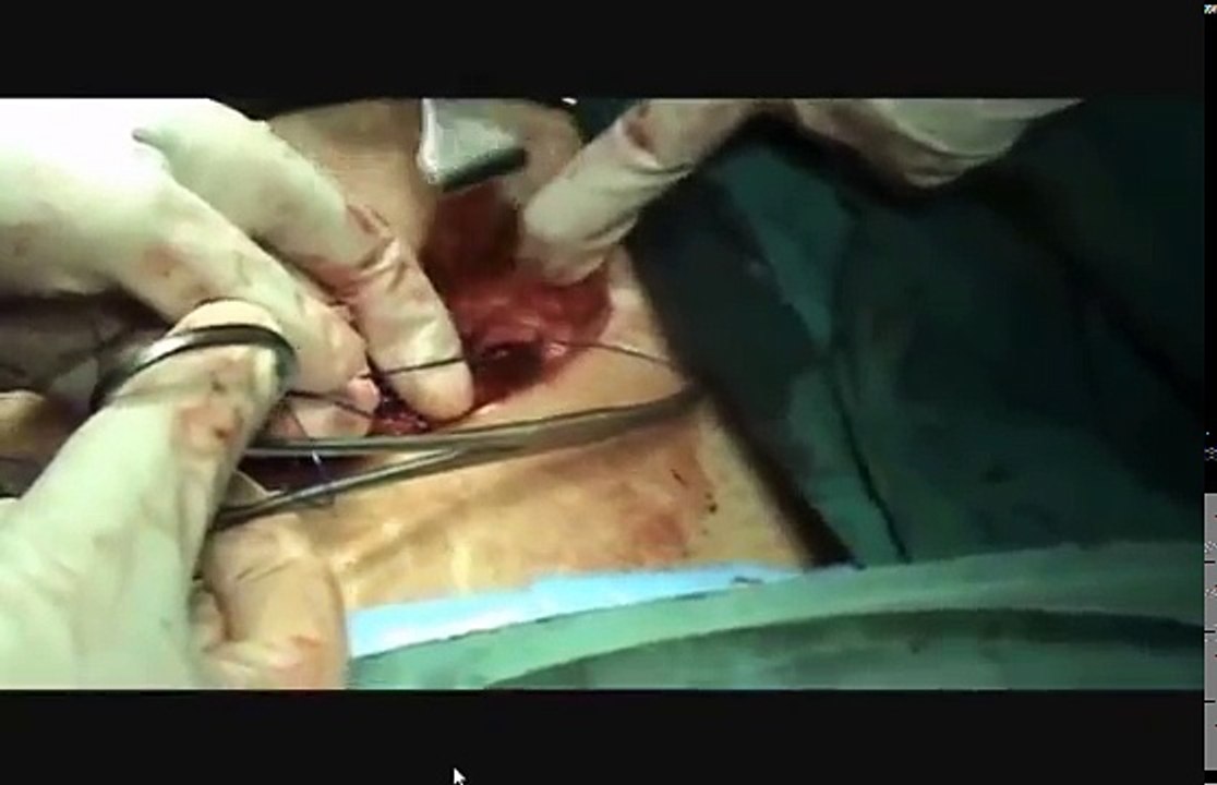 Closing Pfannenstiel Incision