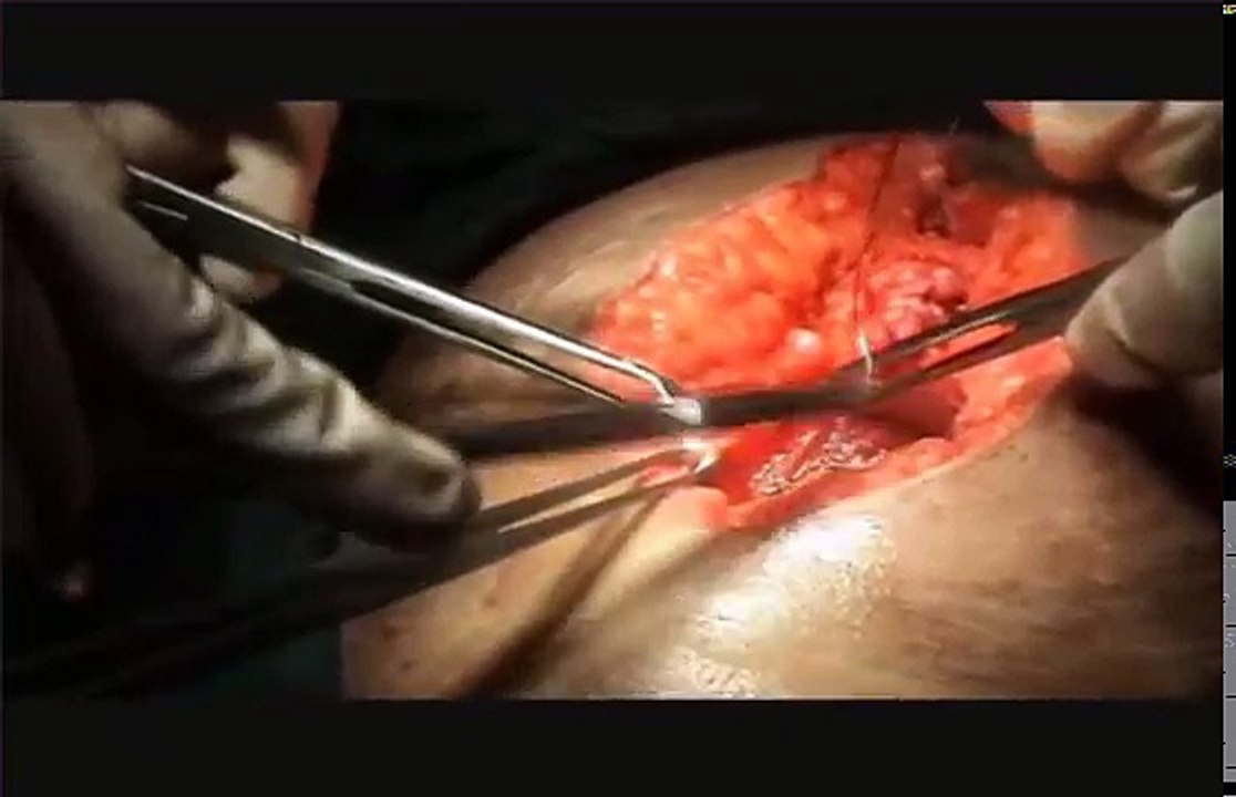 Closing the abdomen with Tension & Mattress Sutures in a vertical Abd incision