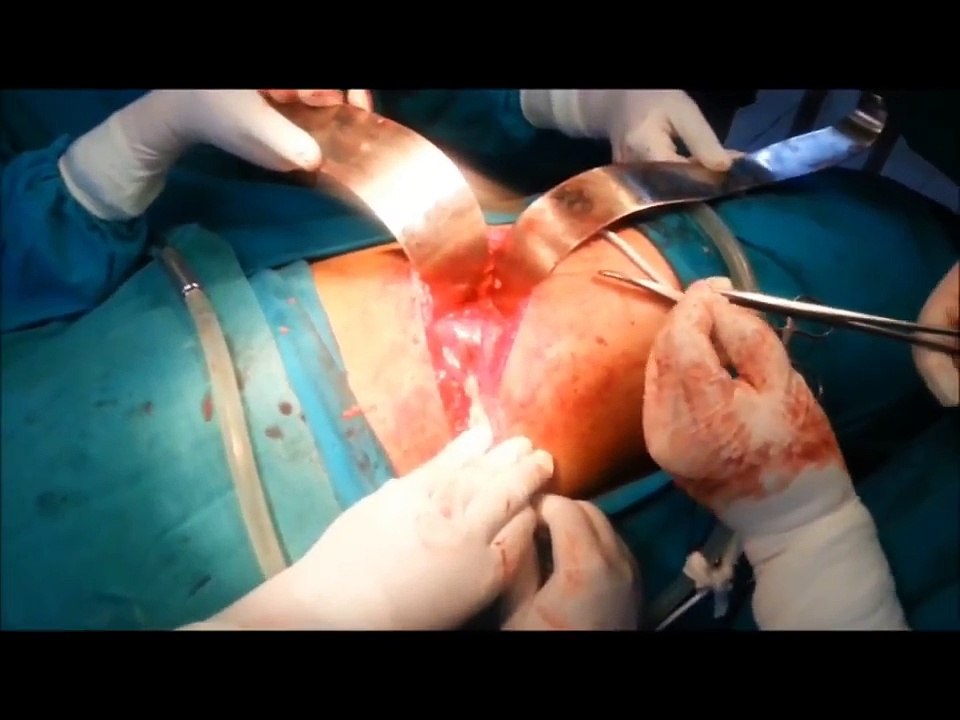 Massive Egg Size Kidney Stone Removal Surgery- Medical Videos