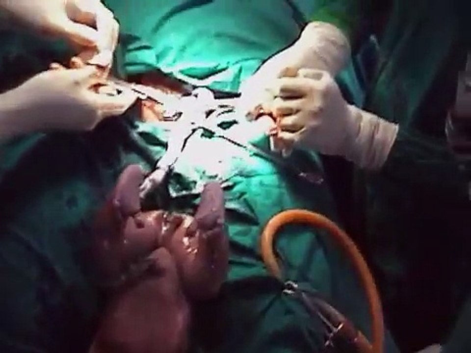 Delivery of the baby and placenta and cleaning the uterine cavity- Medical Videos