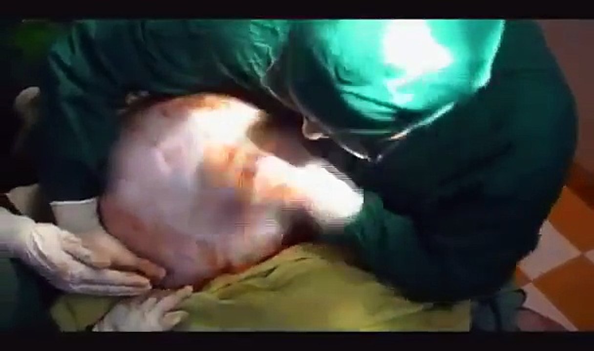 Huge ovarian cyst weighted 24 Kg removal surgery- Medical Videos