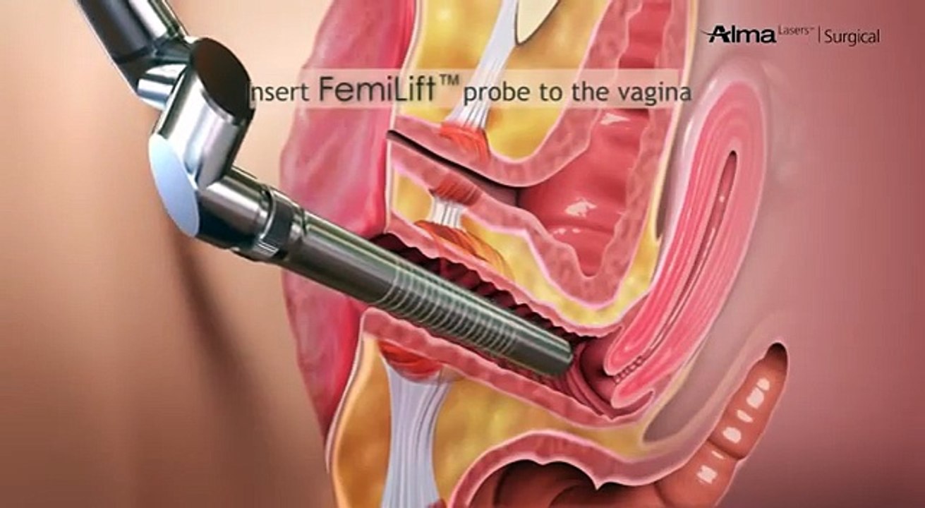 laser vagina tightening surgery- Medical Videos