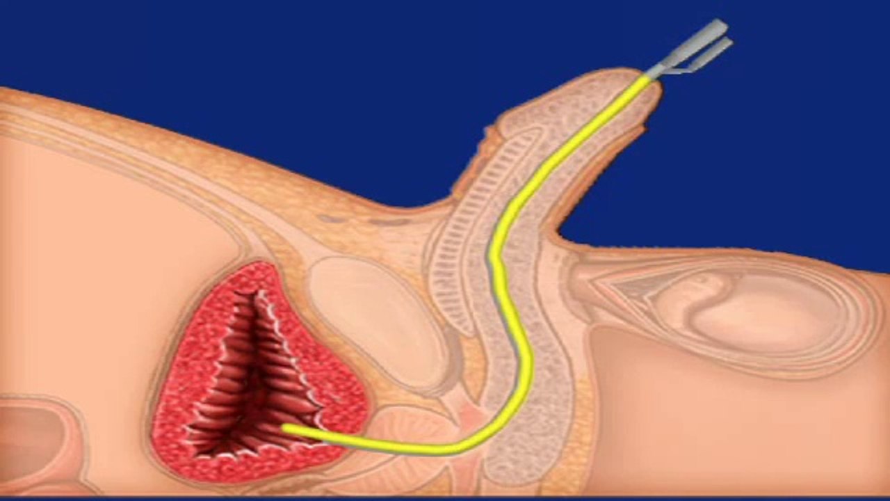 Male Penile Catheter Insertion Procedure- Medical Videos