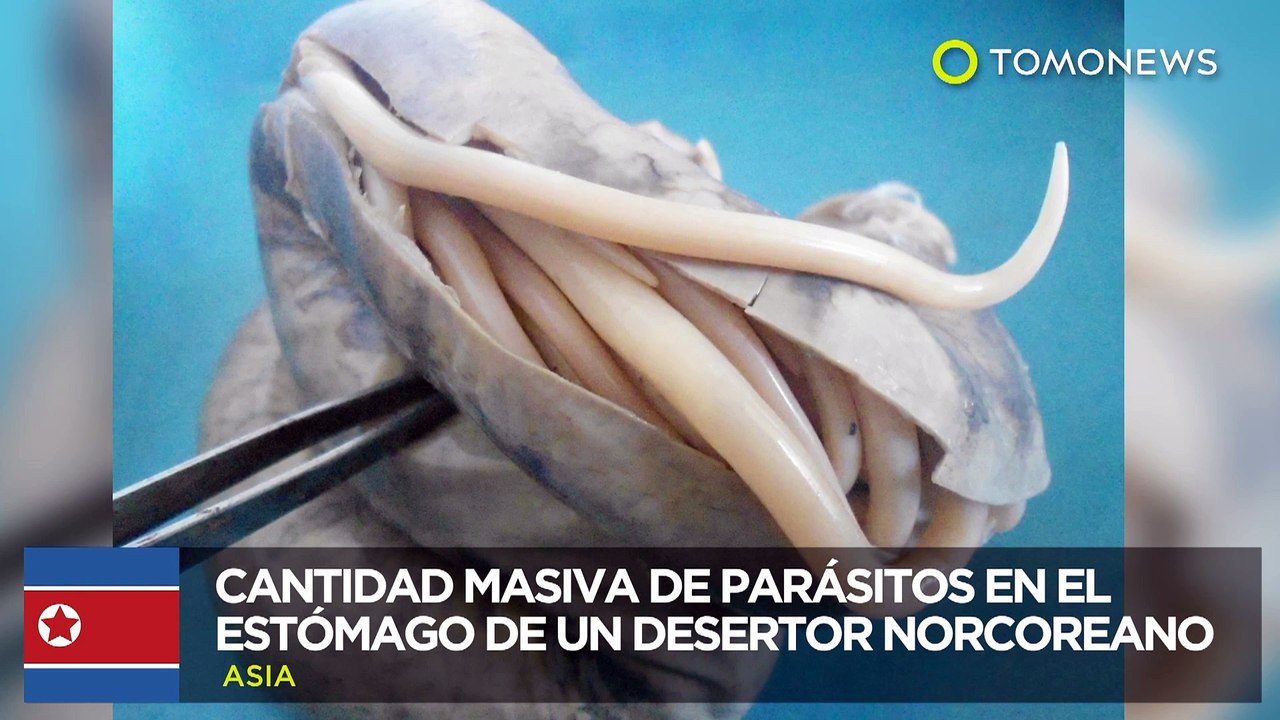 Dieta norcoreana: Estómago de un soldado herido lleno de parásitos - TomoNews