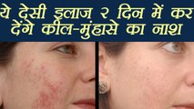 Pimple removal Home Remedies | कील-मुंहासे के लिए घरेलू नुस्खें | Boldsky