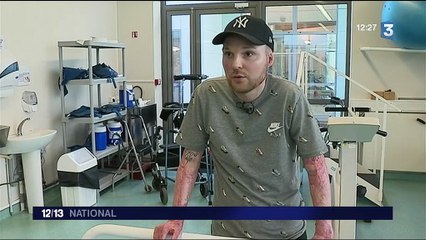 Santé : un grand brûlé sauvé par une greffe de peau de son frère jumeau