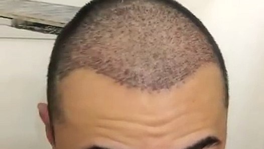 Haartransplantation Erfahrungen 5000 Grafts Elithairtransplant Und Dr Balwi Video Dailymotion