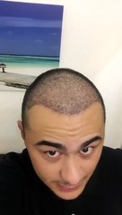 Haartransplantation Erfahrungen 5000 Grafts - Elithairtransplant und Dr. Balwi