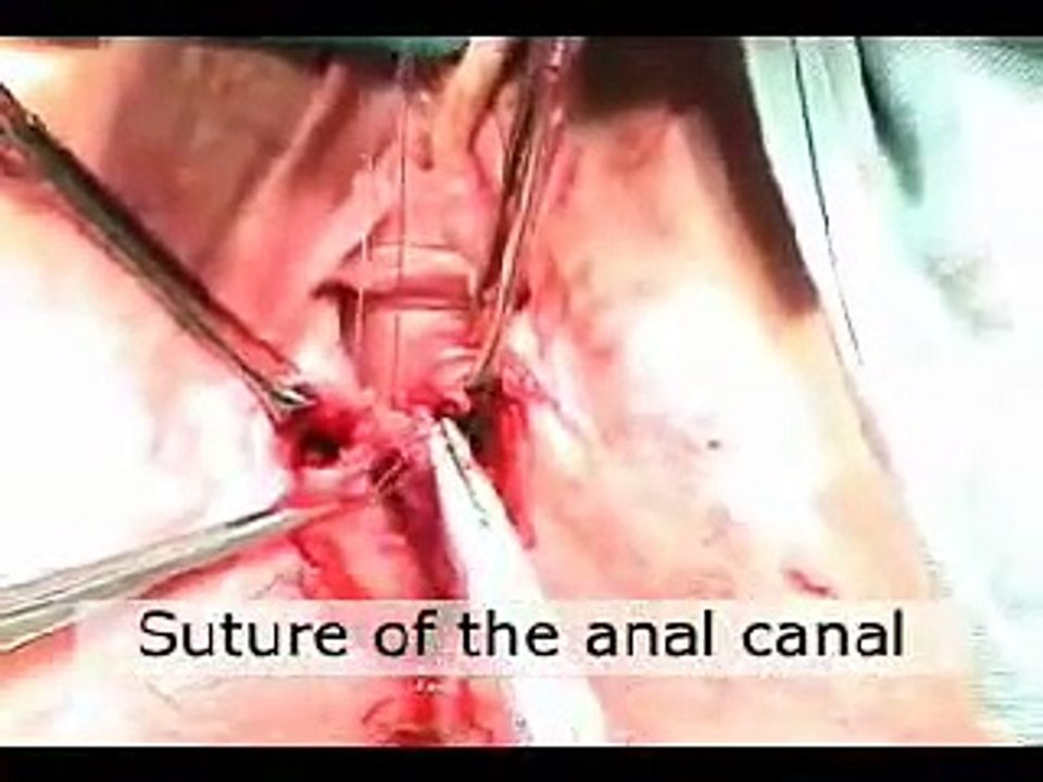 Complete perineal tear and Perineal reconstruction