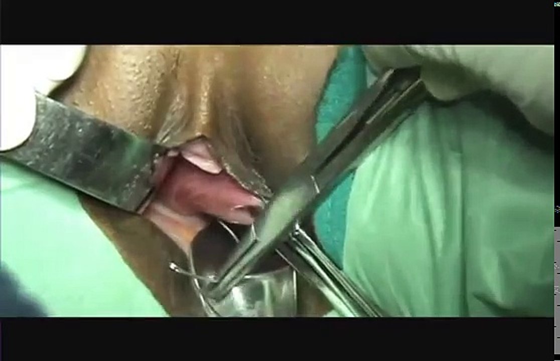 Cervical Cerclage using McDonald Technique