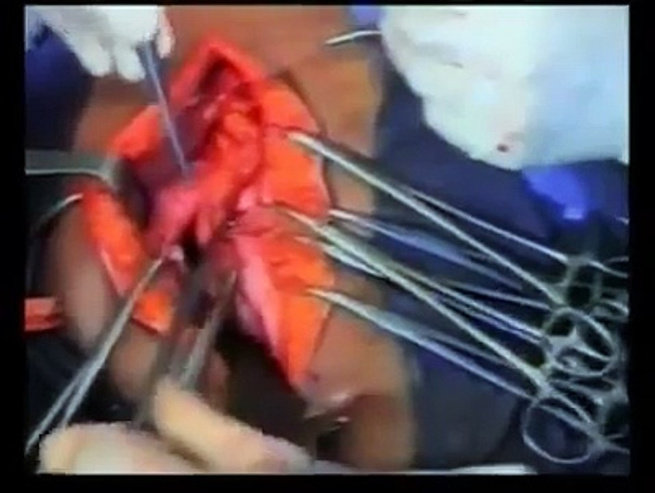 Burst abdomen after exploratory Laparotomy & The Tension Suture