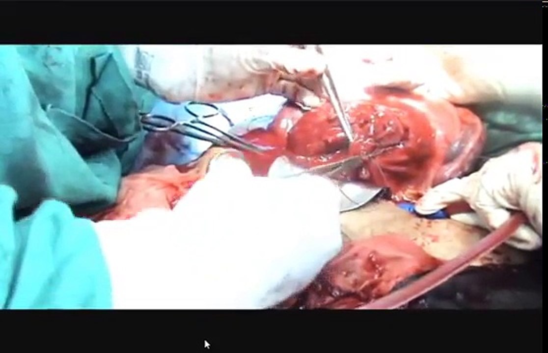 LSCS for Placenta Previa