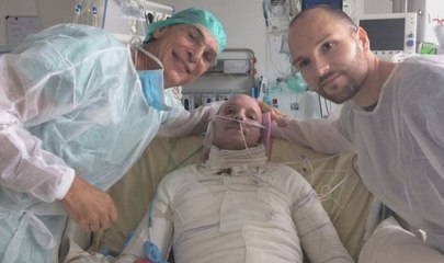 Un brûlé grave sauvé par la peau de son jumeau