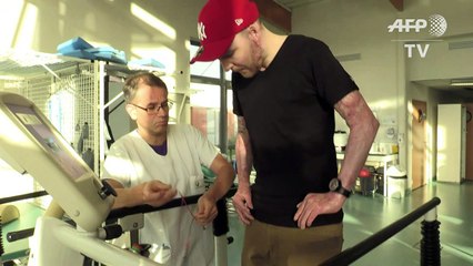 Brandopfer überlebt durch Haut seines Zwillingsbruders