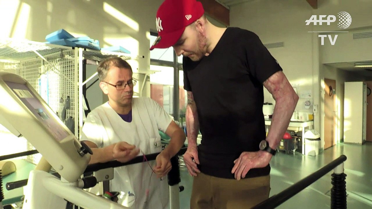 Brandopfer überlebt durch Haut seines Zwillingsbruders