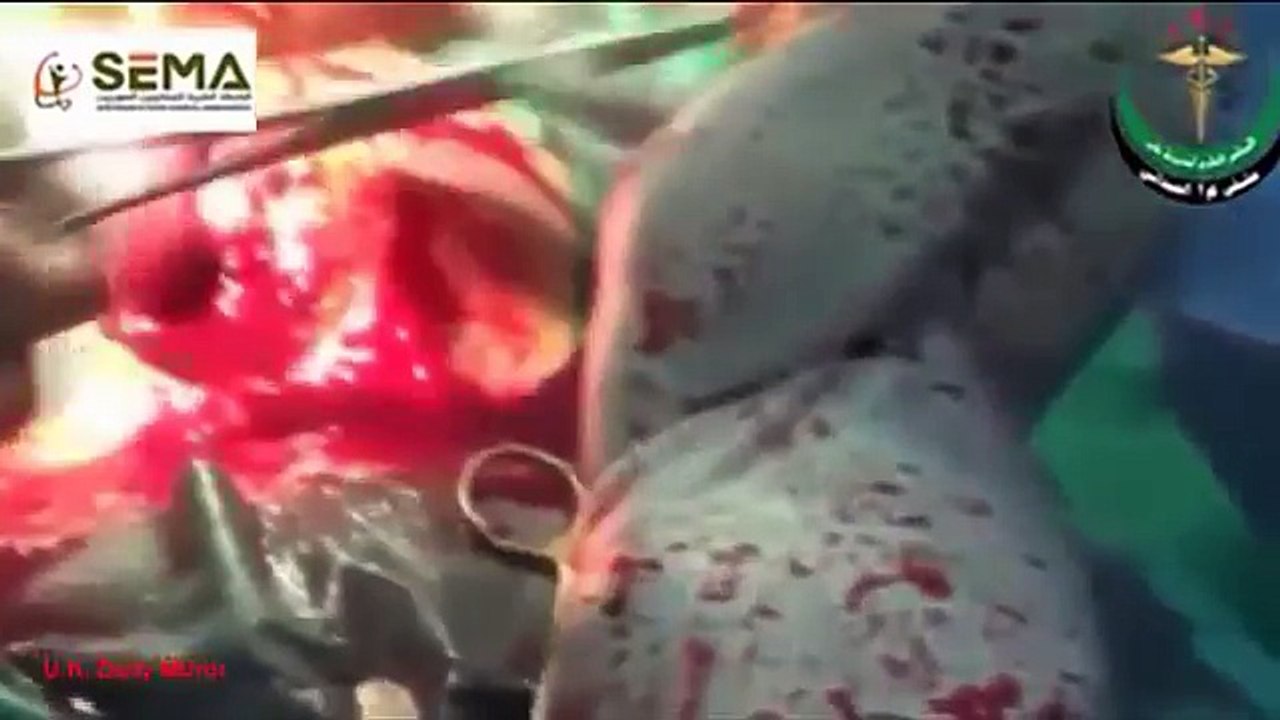 Unborn Baby saved After Mother Is Wounded In Missile Strike in Syria- Medical Videos