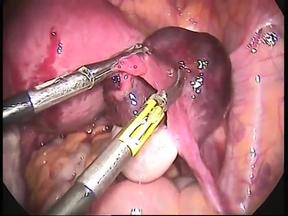 Salpingectomy for Unruptured Ectopic Pregnancy
