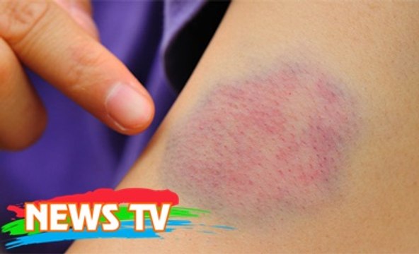 Dấu hiệu sớm của bệnh ung thư máu