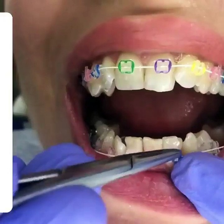 Colored orthodontic