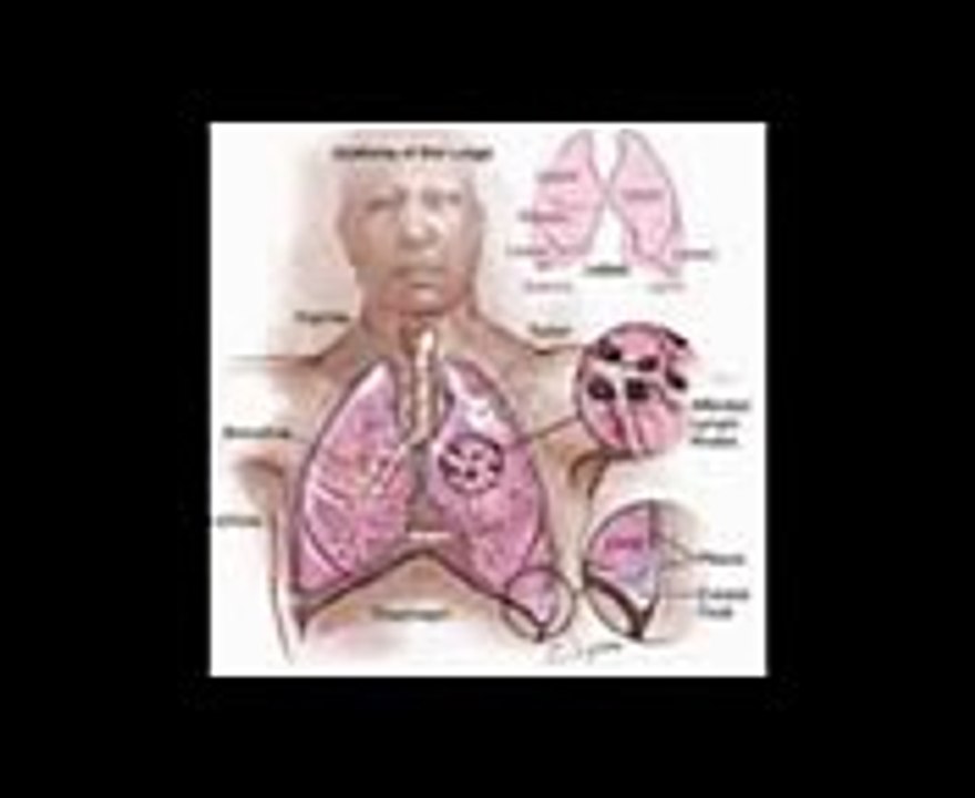 Asbestos Lung Cancer (9)