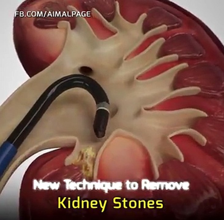 REMOVAL OF KIDNEY STONES new effective process